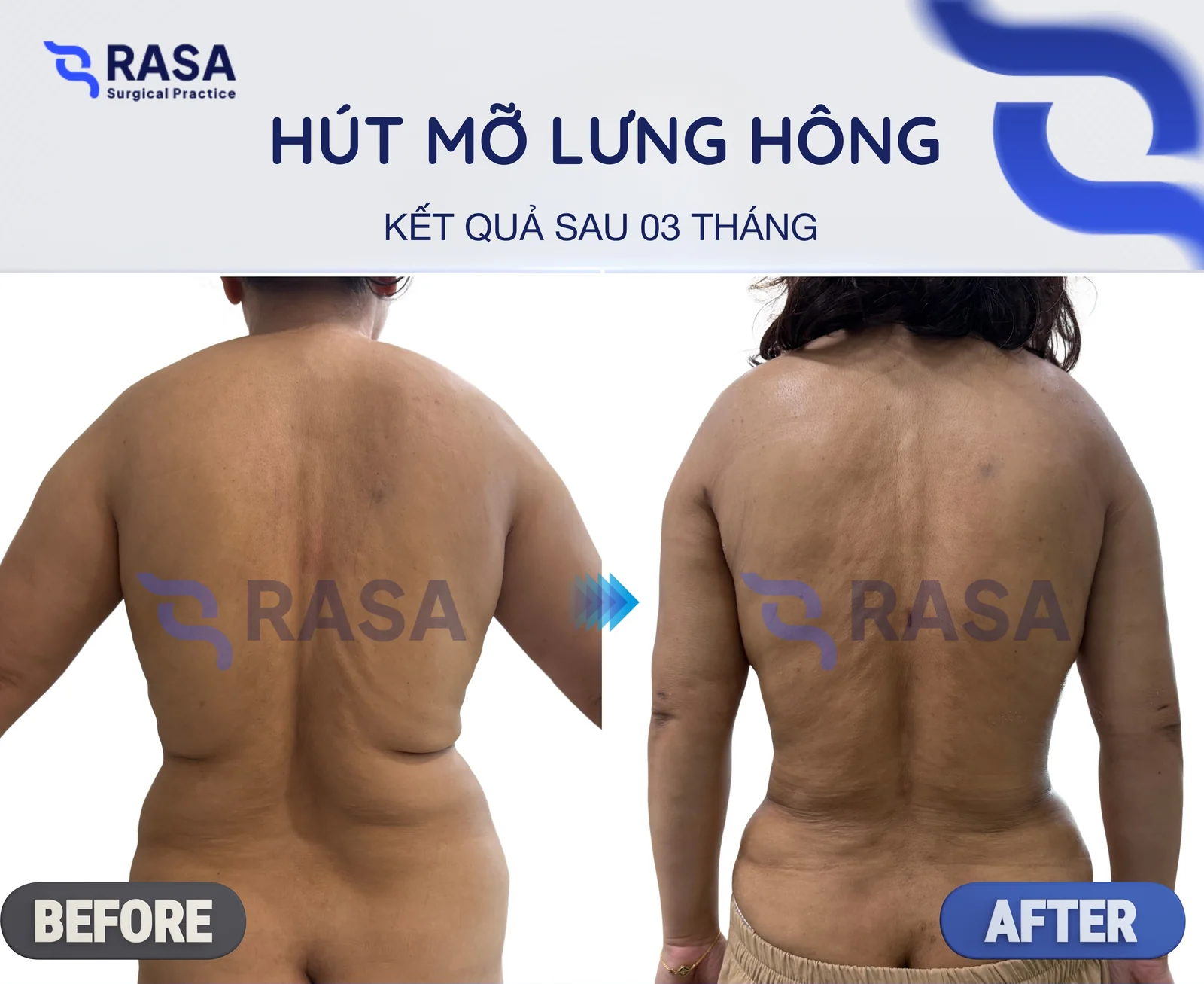 Hút mỡ lưng hông - Sau 3 tháng