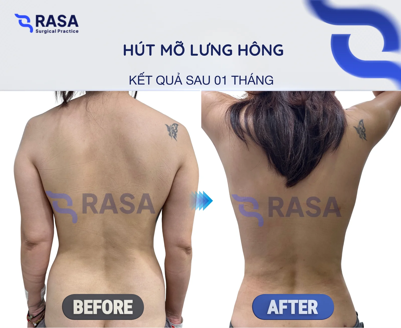 Back & flank liposuction - After 1 month