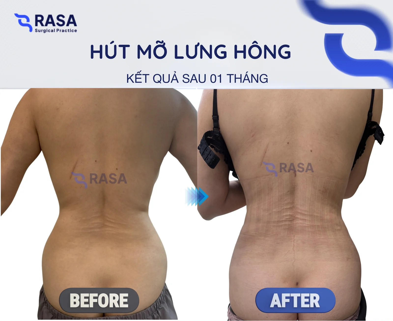 Back & flank liposuction - After 1 month