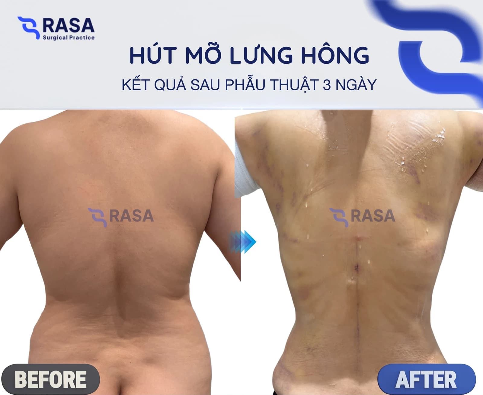 Back & flank liposuction - After 3 days