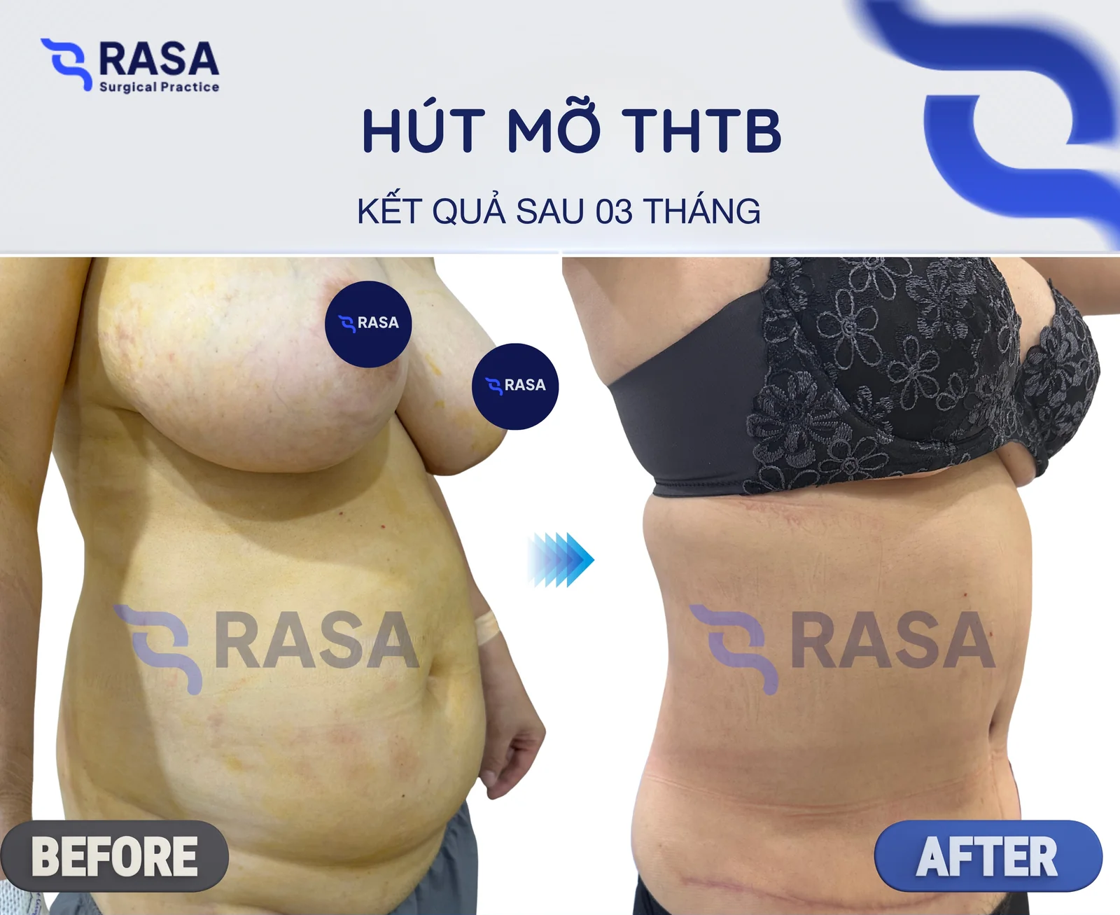 Hút mỡ tạo hình thành bụng - Sau 3 tháng