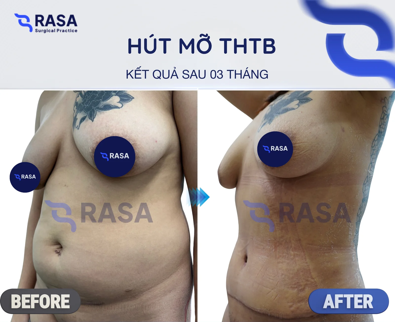 Hút mỡ tạo hình thành bụng - Sau 3 tháng