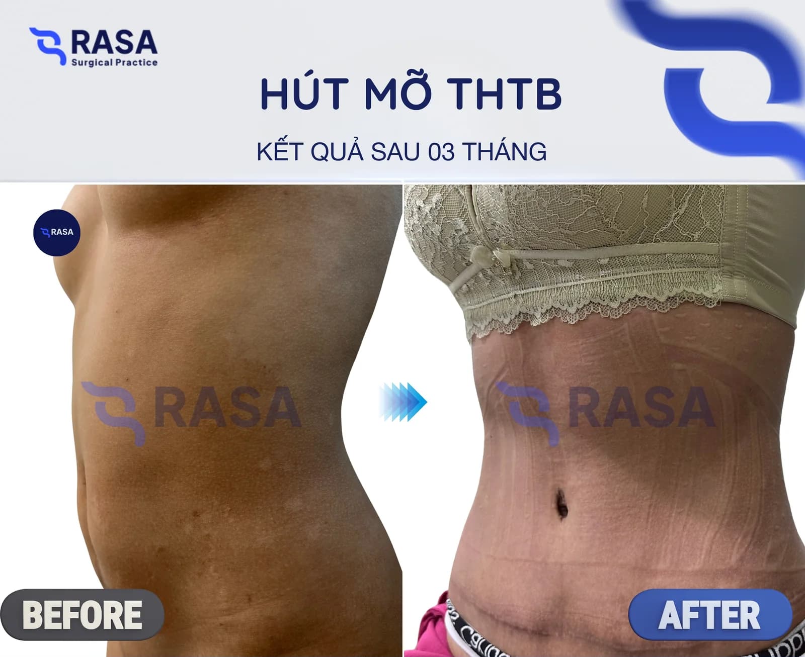 Hút mỡ tạo hình thành bụng - Sau 3 tháng