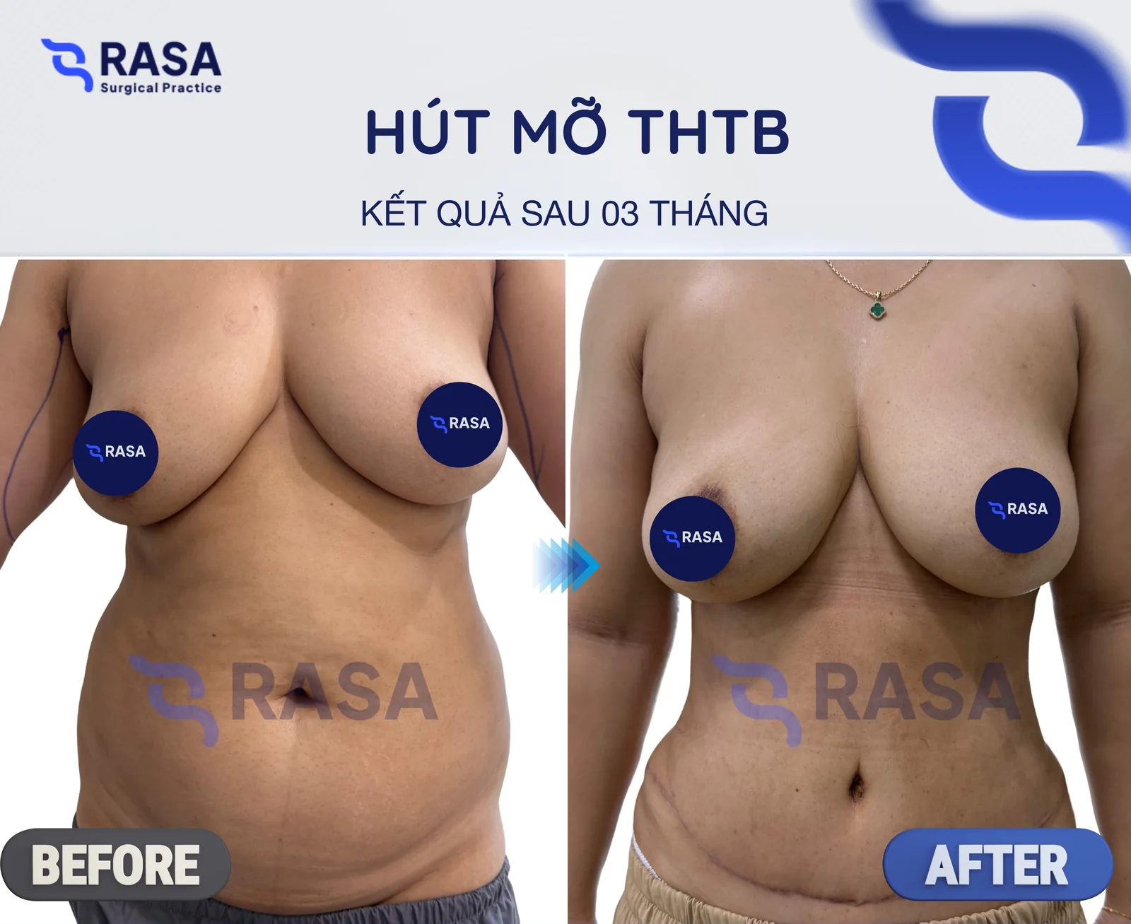 Hút mỡ tạo hình thành bụng - Sau 3 tháng
