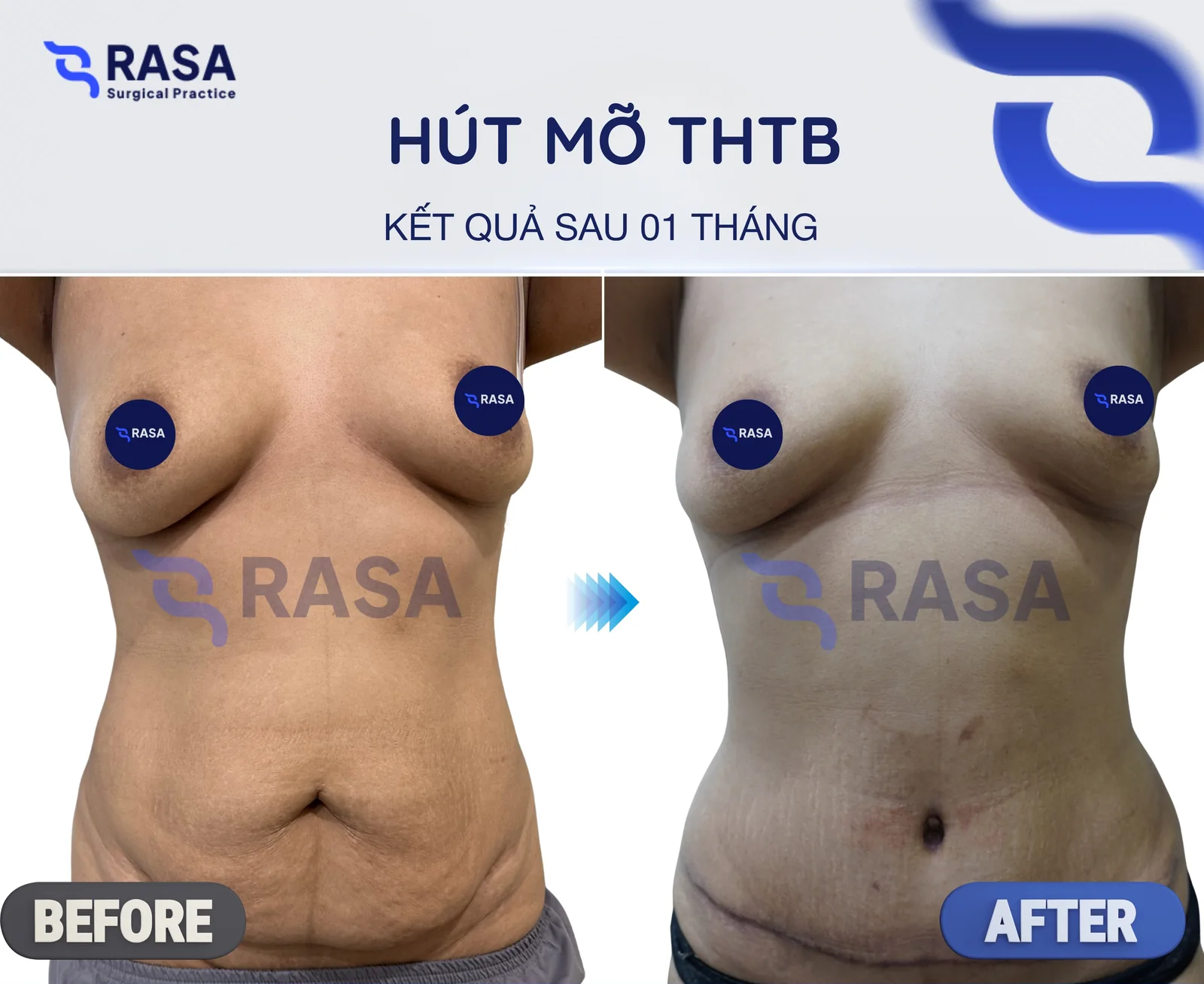Hút mỡ tạo hình thành bụng - Sau 1 tháng