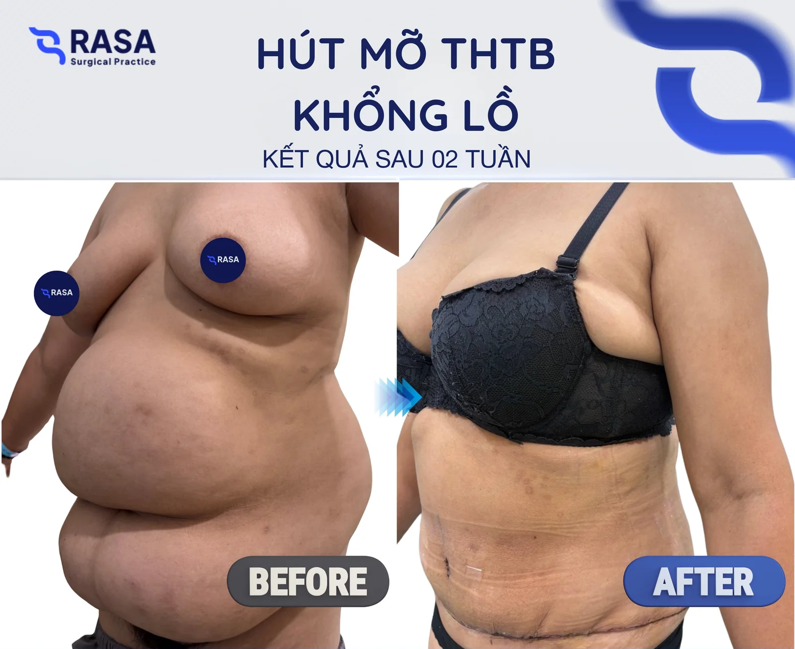 Hút mỡ tạo hình thành bụng phì đại - Sau 2 tuần