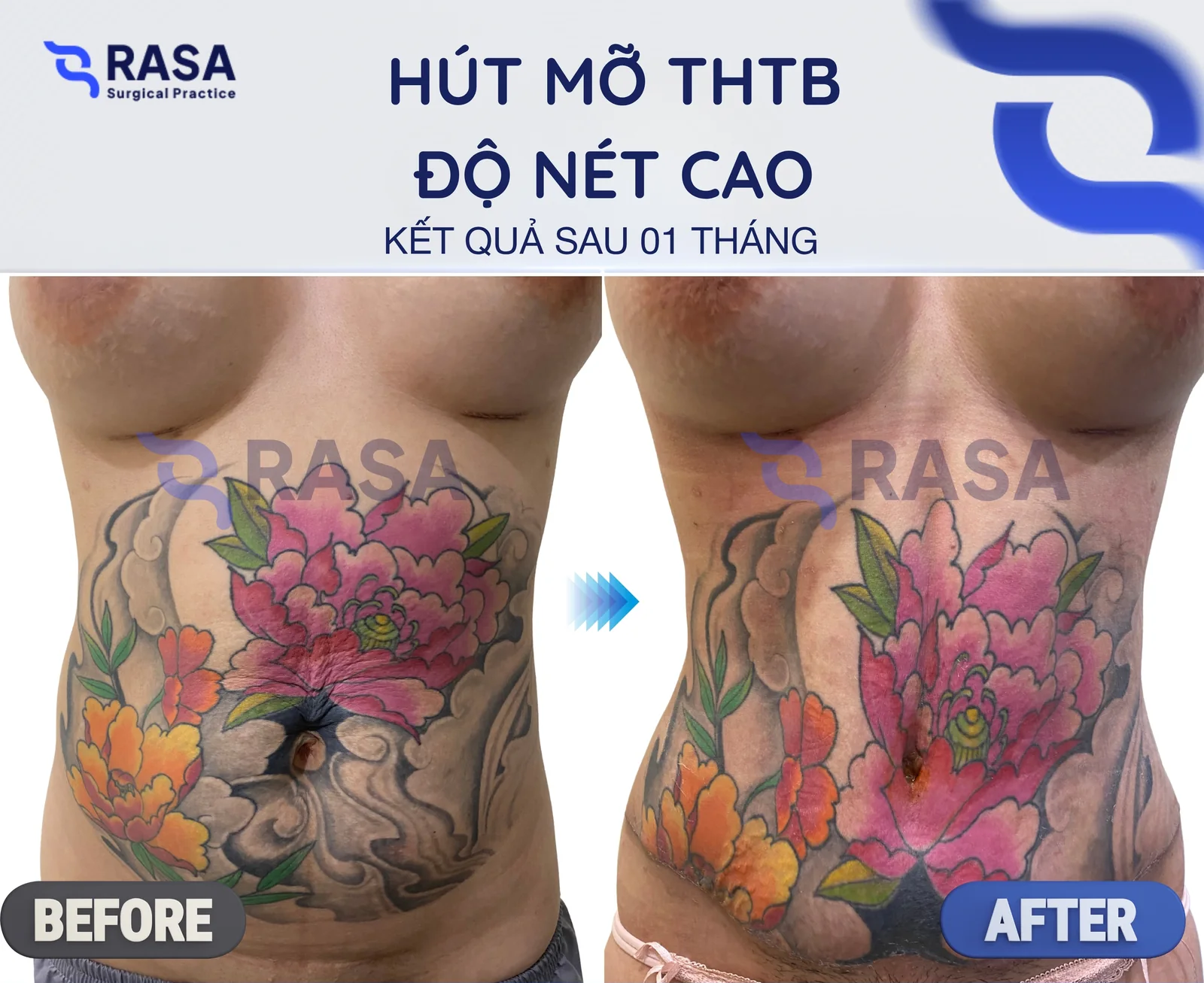 Hút mỡ tạo hình thành bụng - độ nét cao - Sau 1 tháng