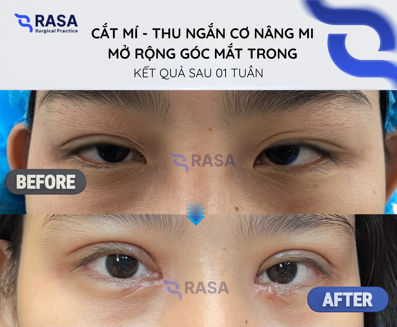 Cắt mí - thu ngắn cơ nâng mi + mở rộng góc mắt trong - Sau 1 tuần