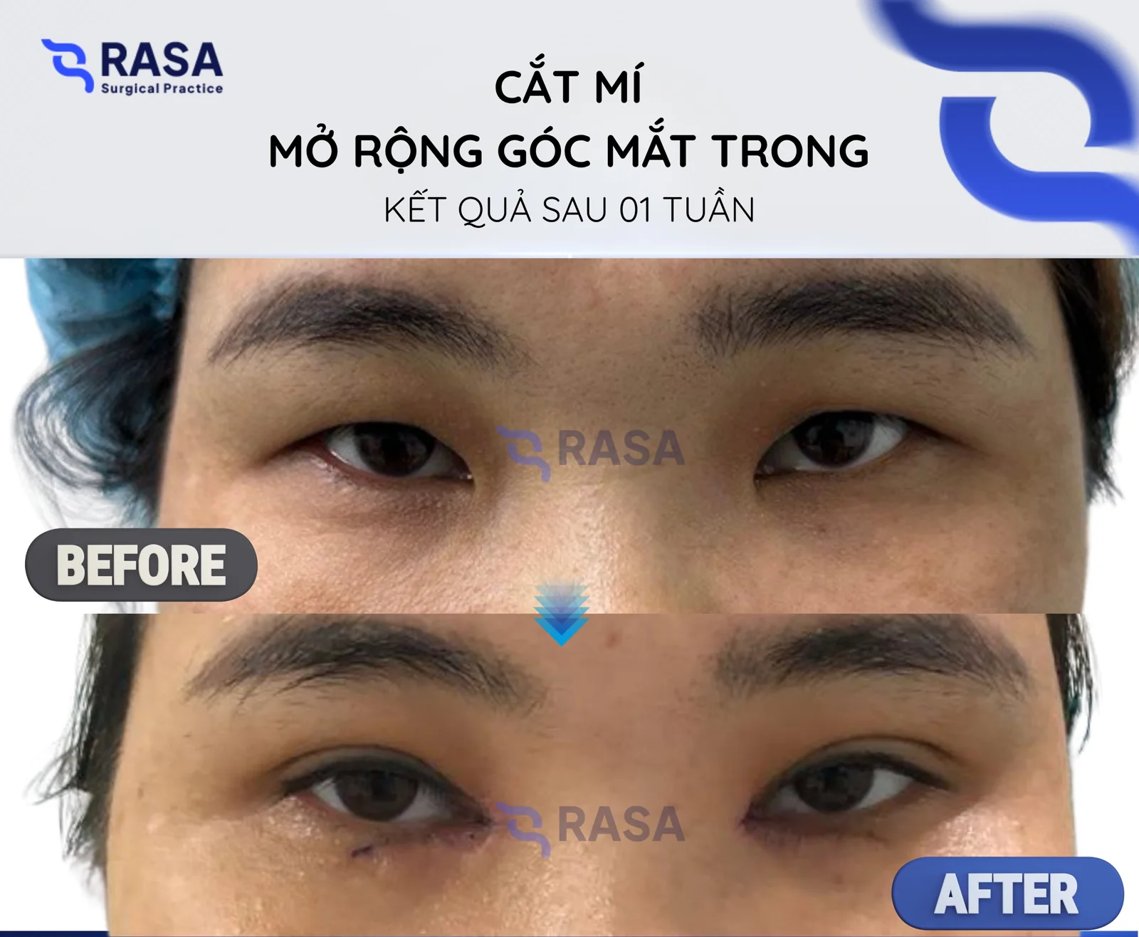 Blepharoplasty - medial epicanthoplasty - After 1 week