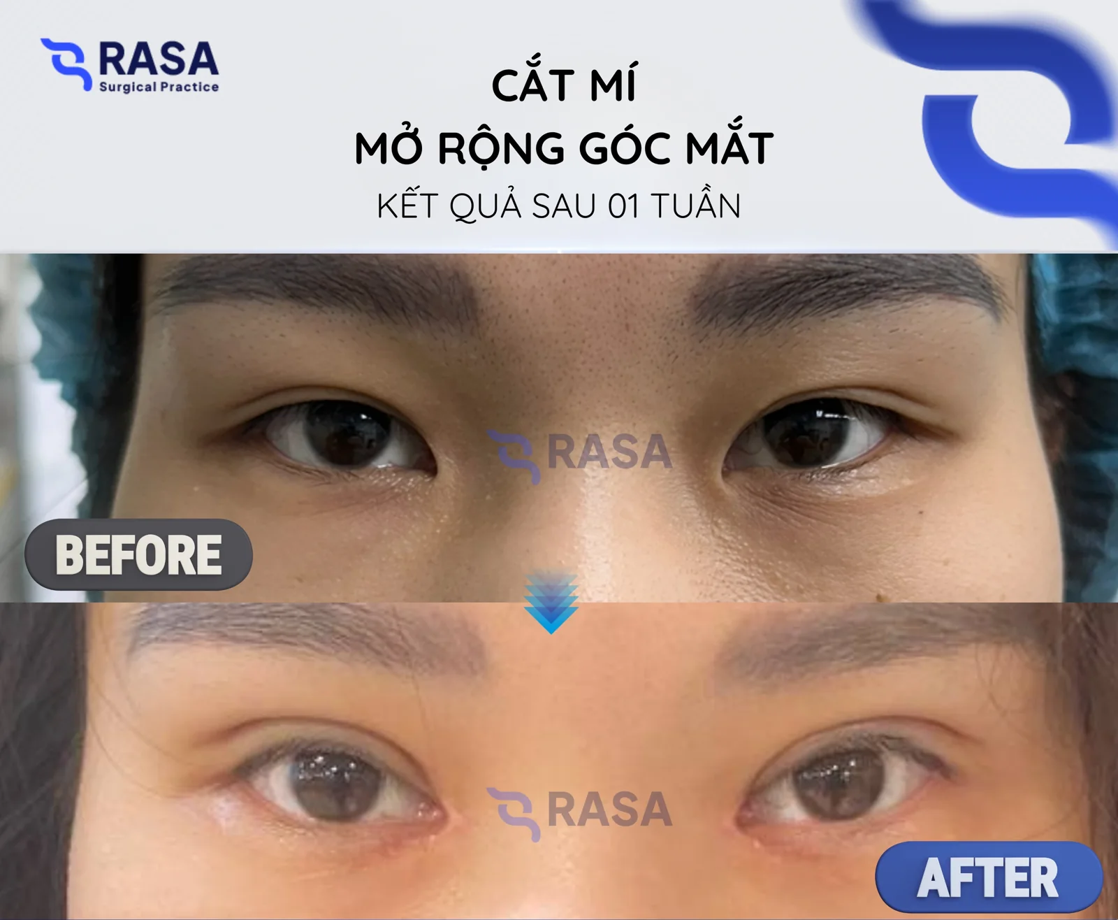 Blepharoplasty - epicanthoplasty - After 1 week