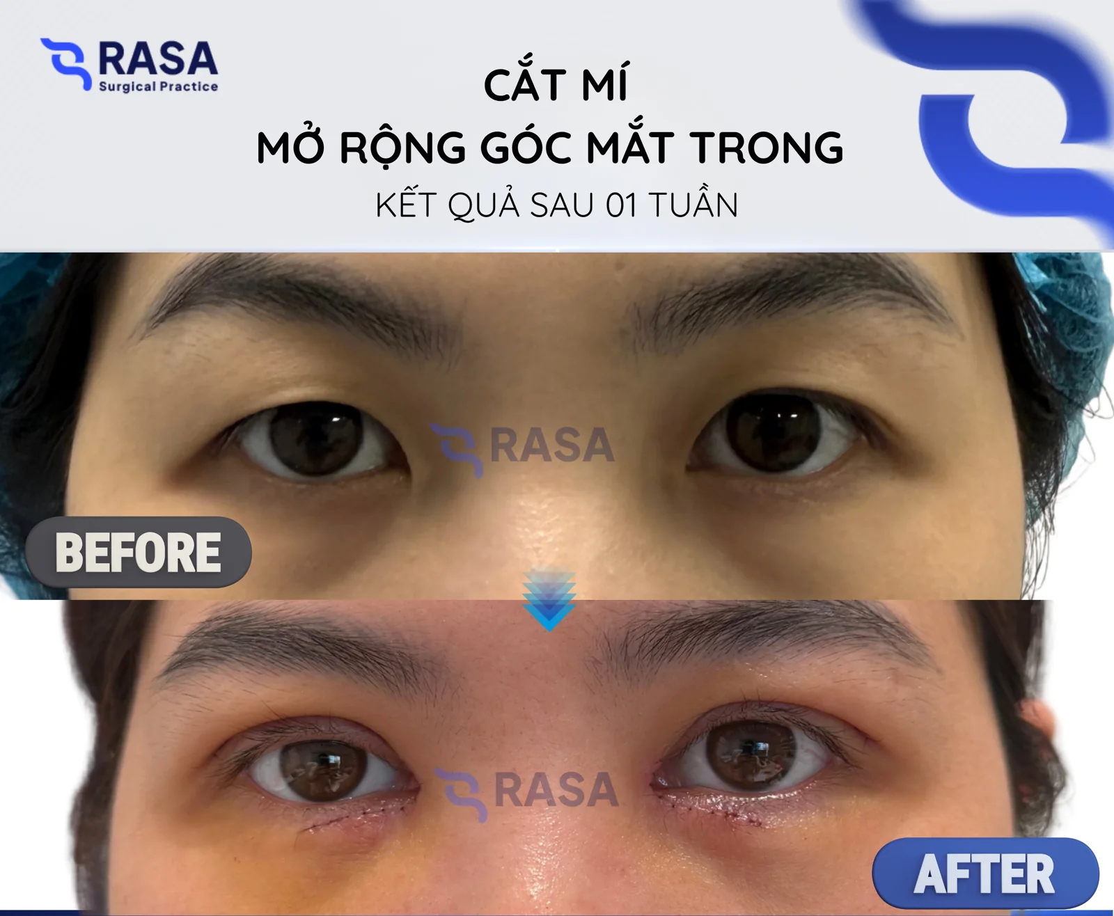 Blepharoplasty - medial epicanthoplasty - After 1 week