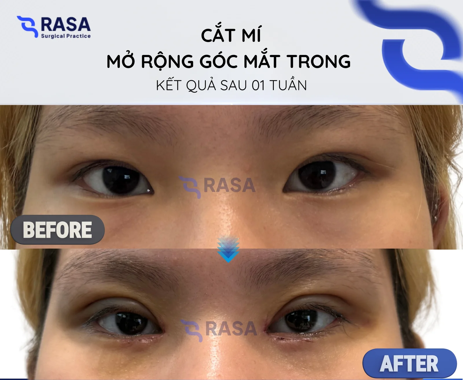 Blepharoplasty - medial epicanthoplasty - After 1 week