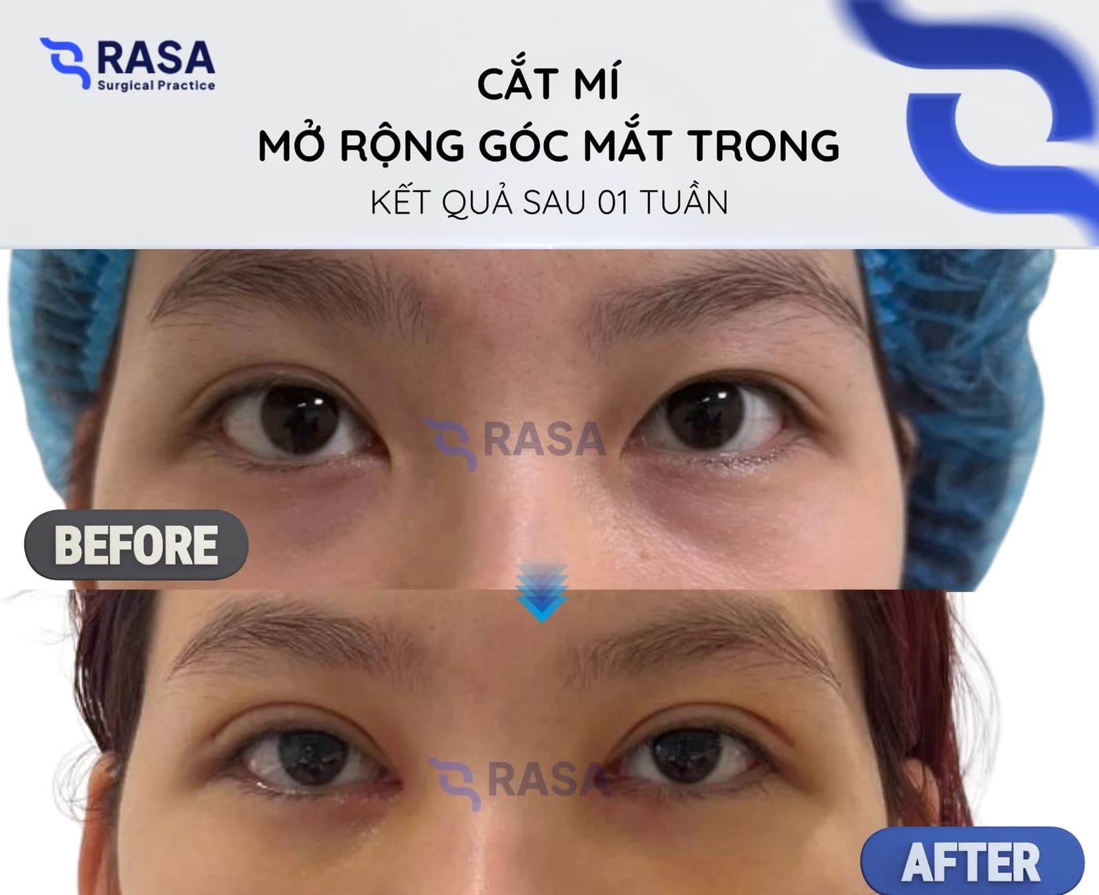 Cắt mí - mở rộng góc mắt trong - Sau 1 tuần