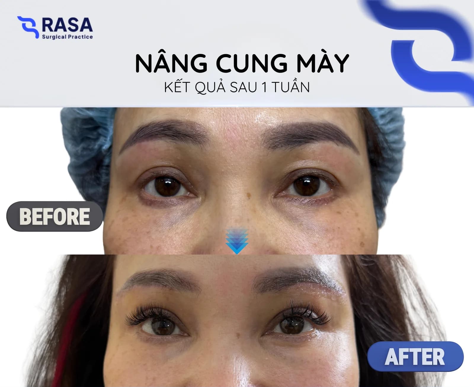 Nâng cung mày - Sau 1 tuần