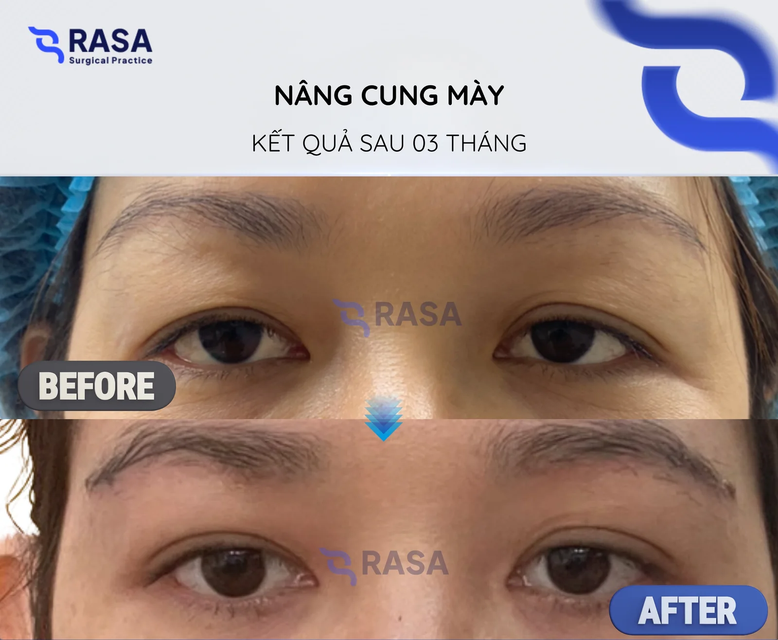 Nâng cung mày - Sau 3 tháng
