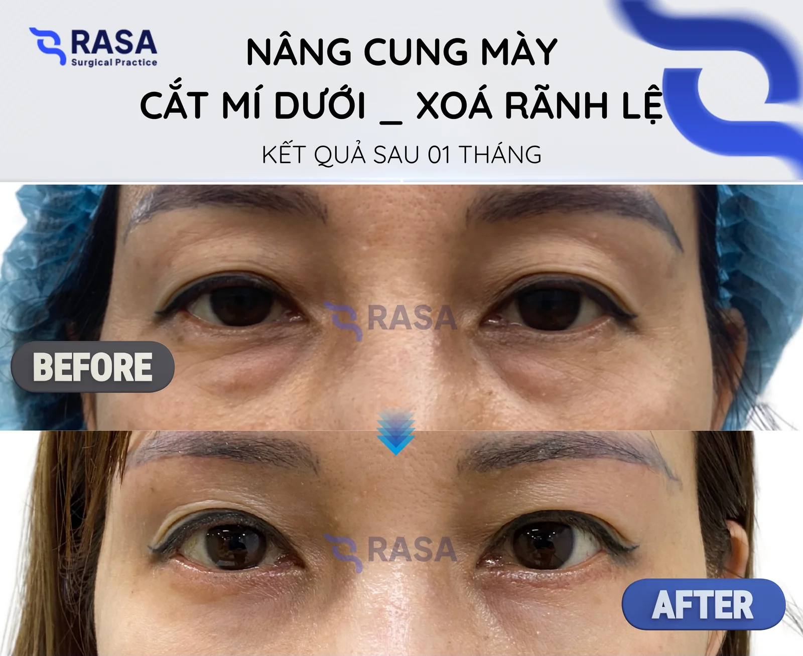 Nâng cung mày + cắt mí dưới - xoá rãnh lệ - Sau 1 tháng