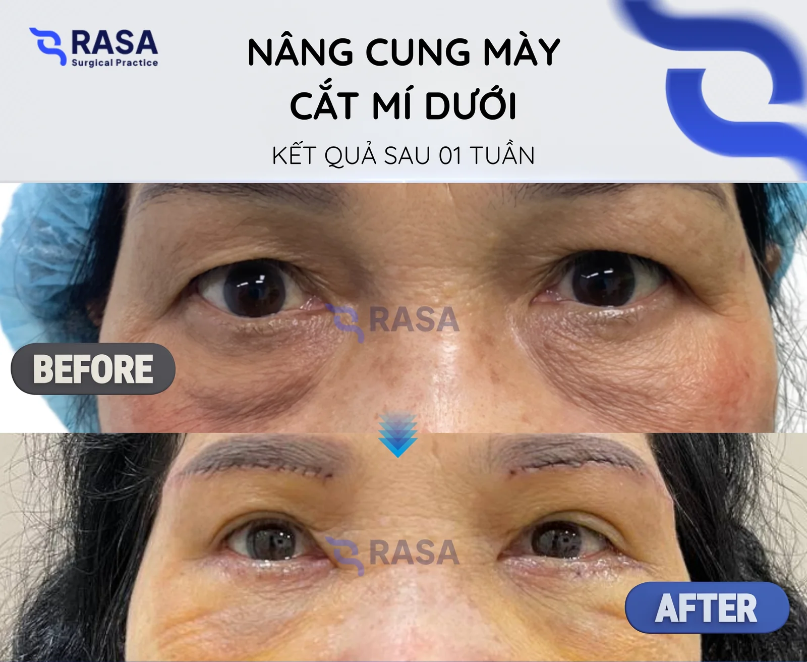 Nâng cung mày + cắt mí dưới - Sau 1 tuần