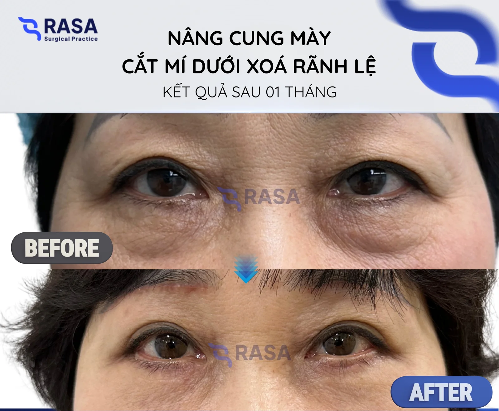 Brow lift - lower blepharoplasty, tear-trough correction - After 1 month