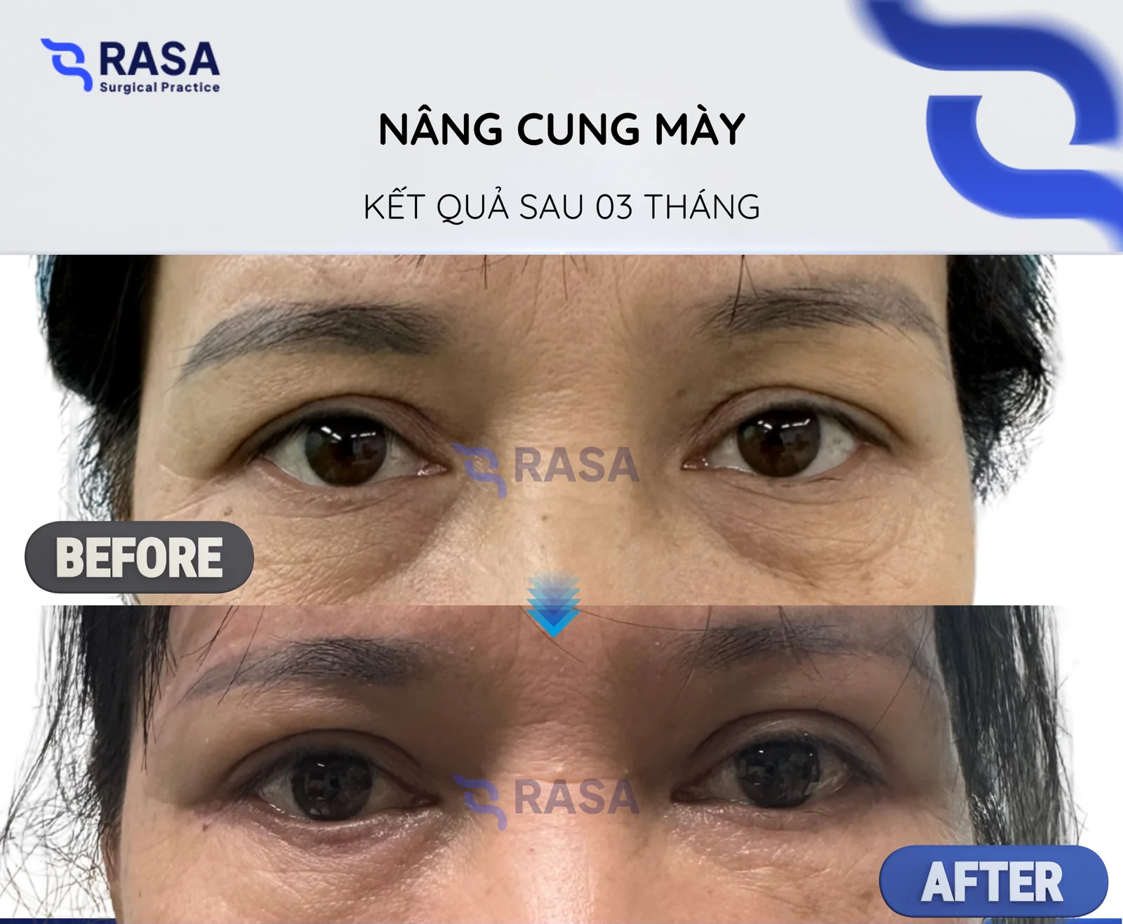 Brow lift - After 3 months