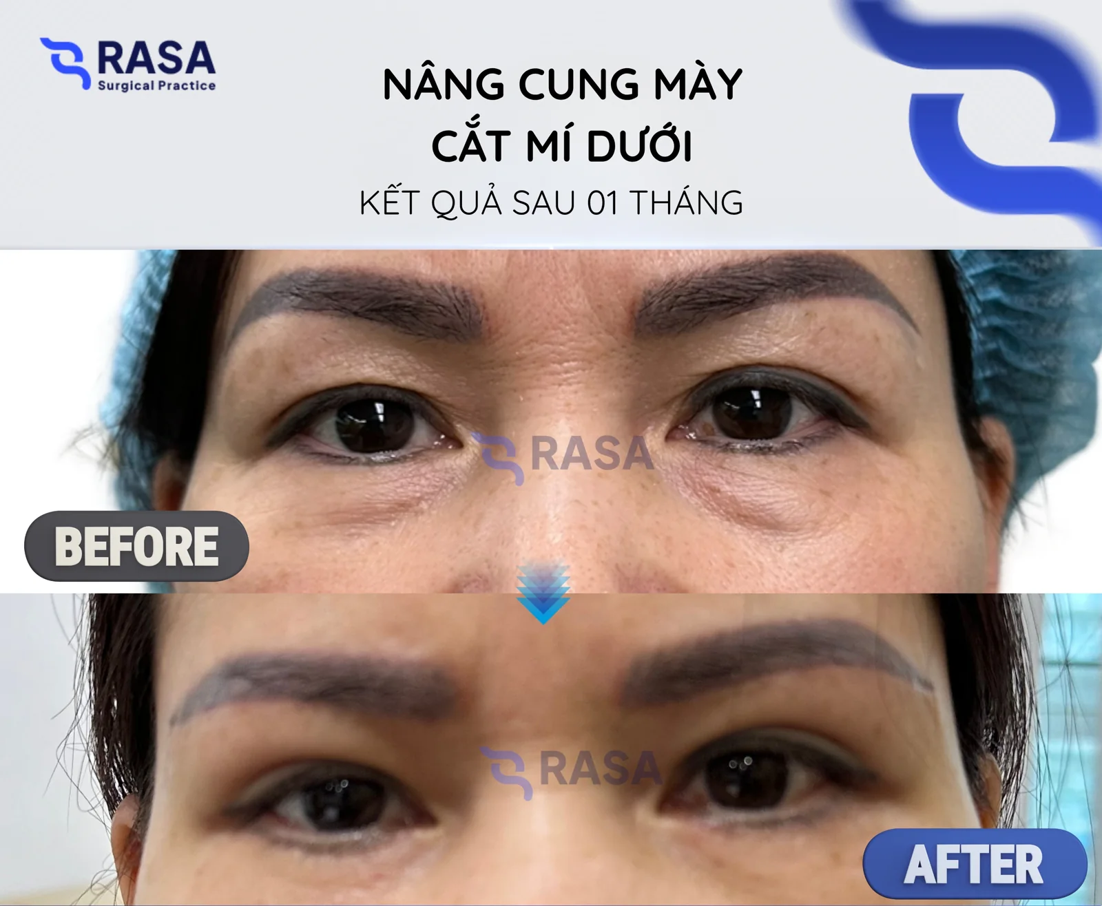 Brow lift - lower blepharoplasty - After 1 month