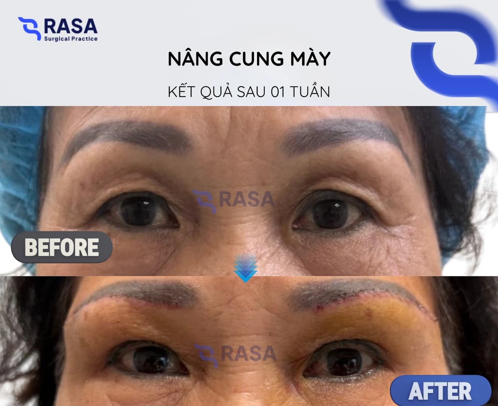 Nâng cung mày - Sau 1 tuần