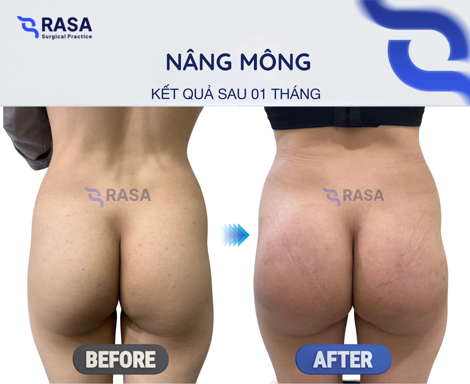 Buttock augmentation - After 1 month