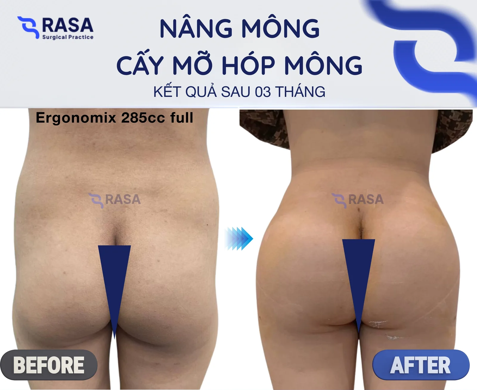Nâng mông + cấy mỡ hóp mông - Sau 3 tháng