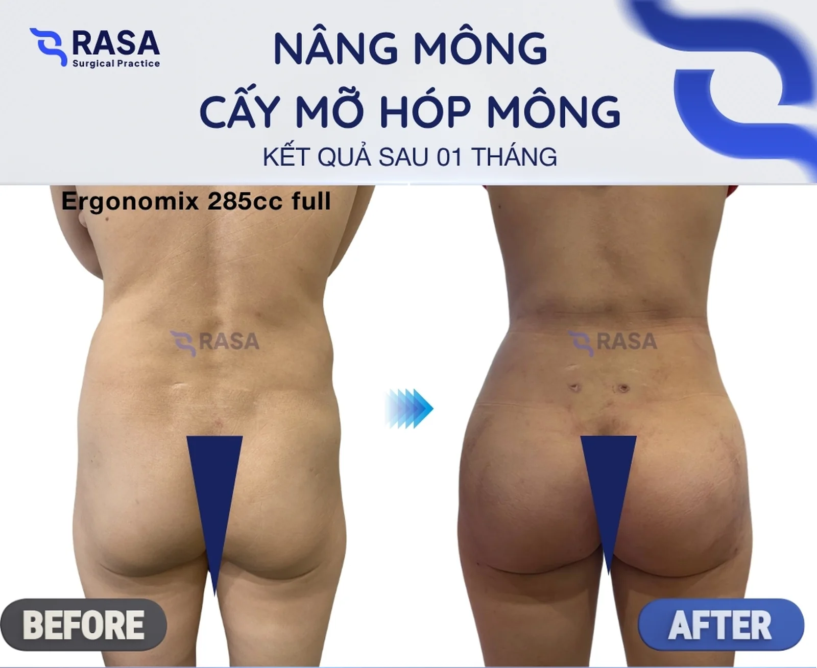 Nâng mông + cấy mỡ hóp mông - Sau 1 tháng