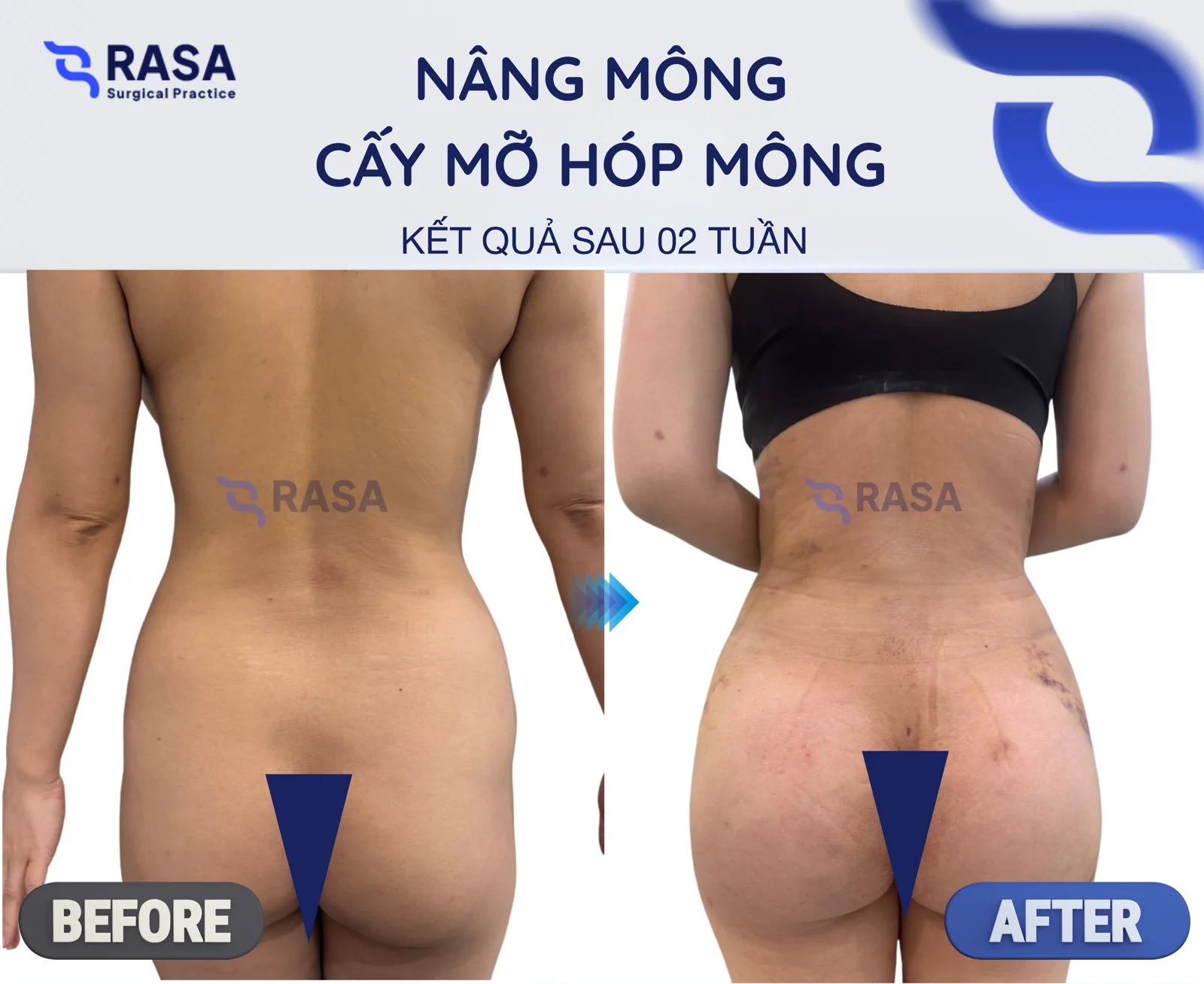 Buttock augmentation - hip-dip fat grafting - After 2 weeks