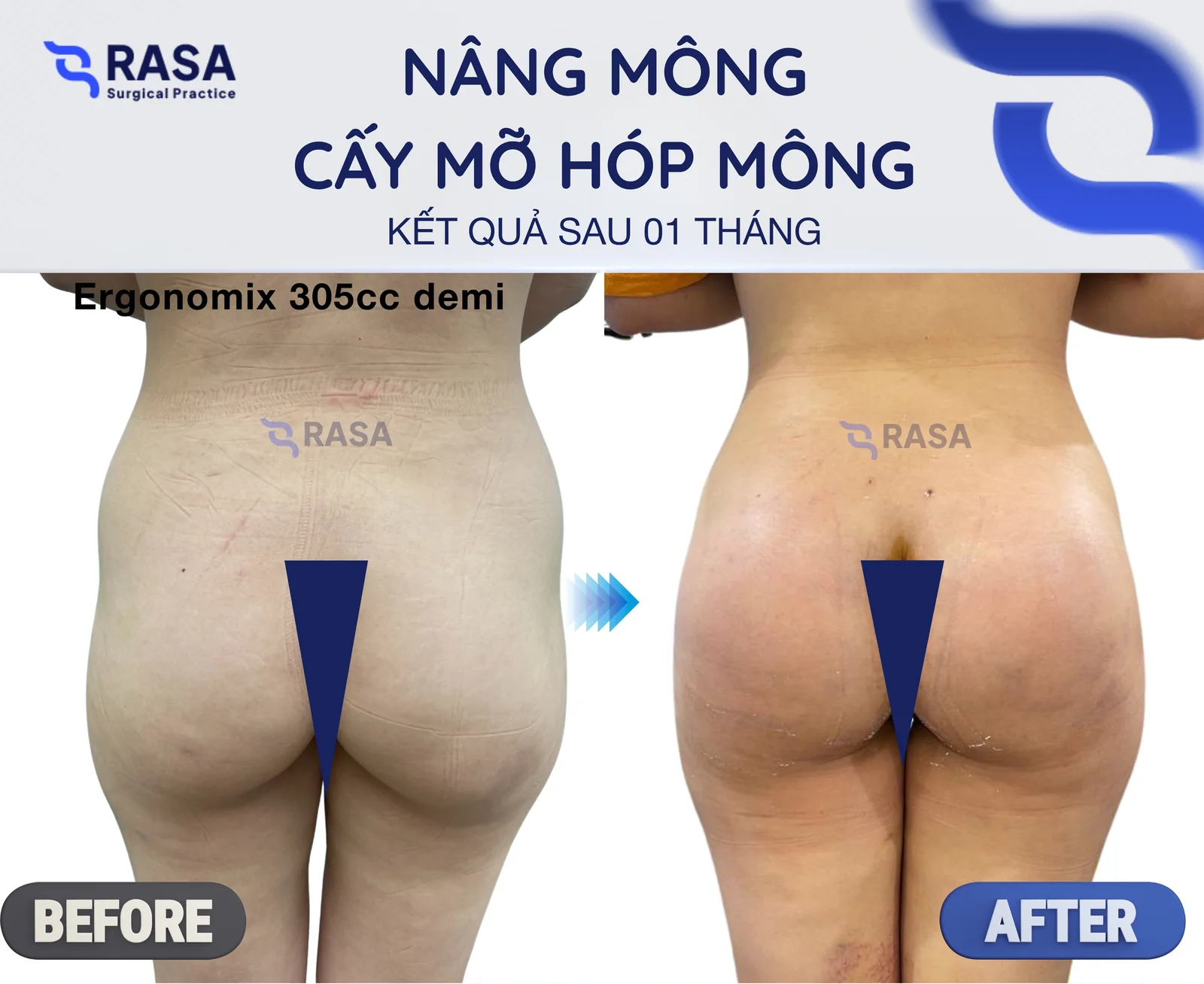 Nâng mông + cấy mỡ hóp mông - Sau 1 tháng