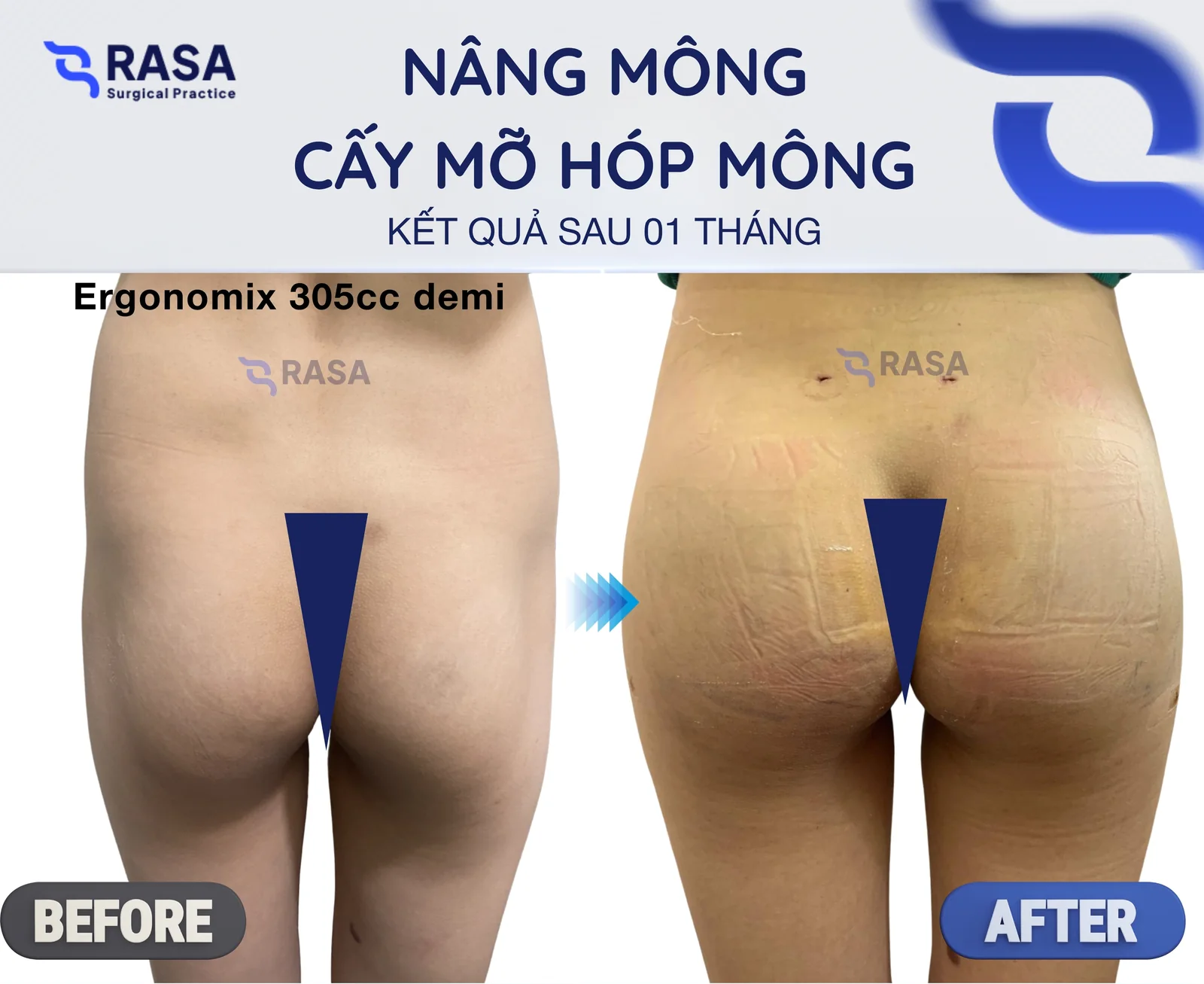Nâng mông + cấy mỡ hóp mông - Sau 1 tháng