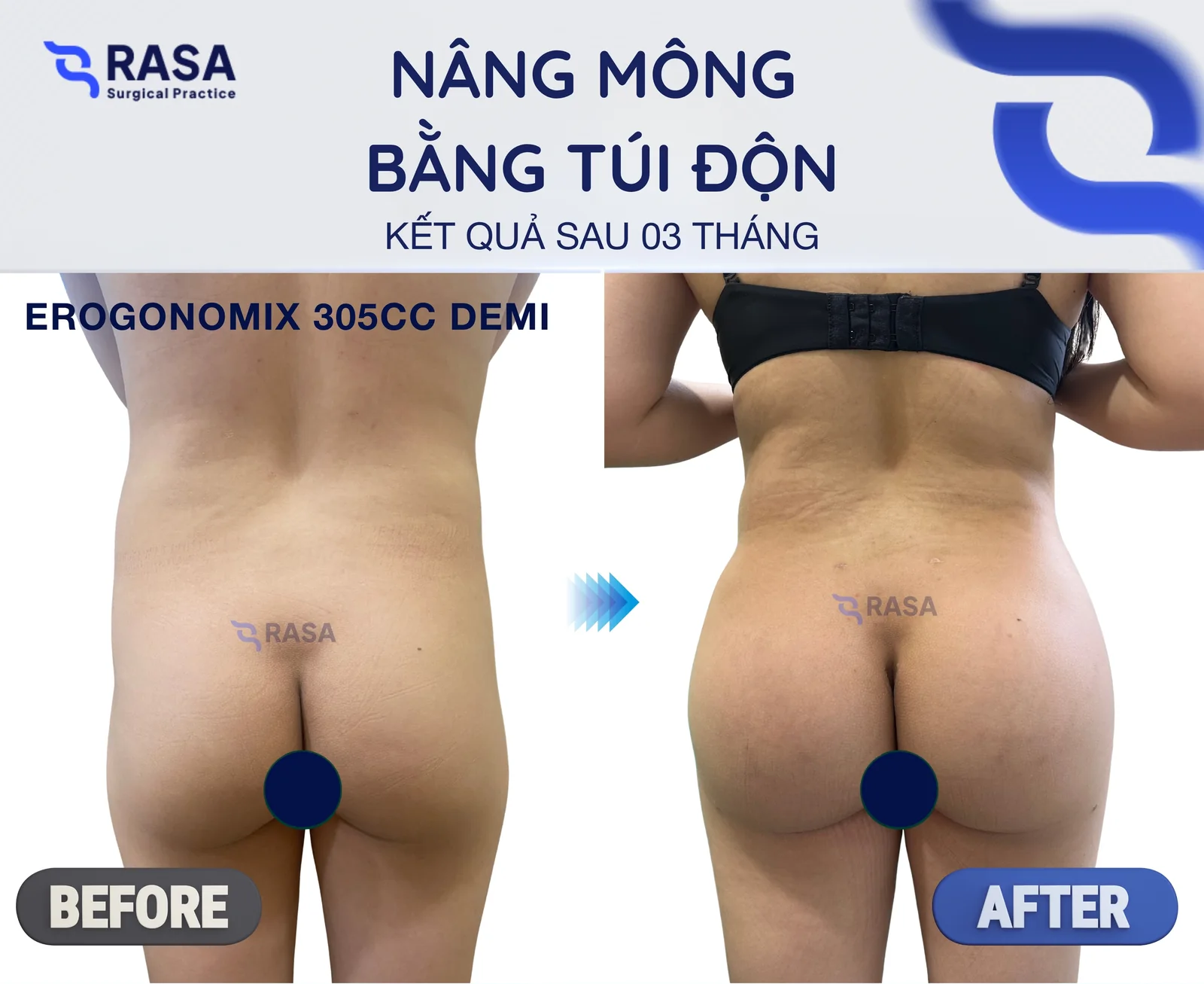 Nâng mông bằng túi độn - Sau 3 tháng