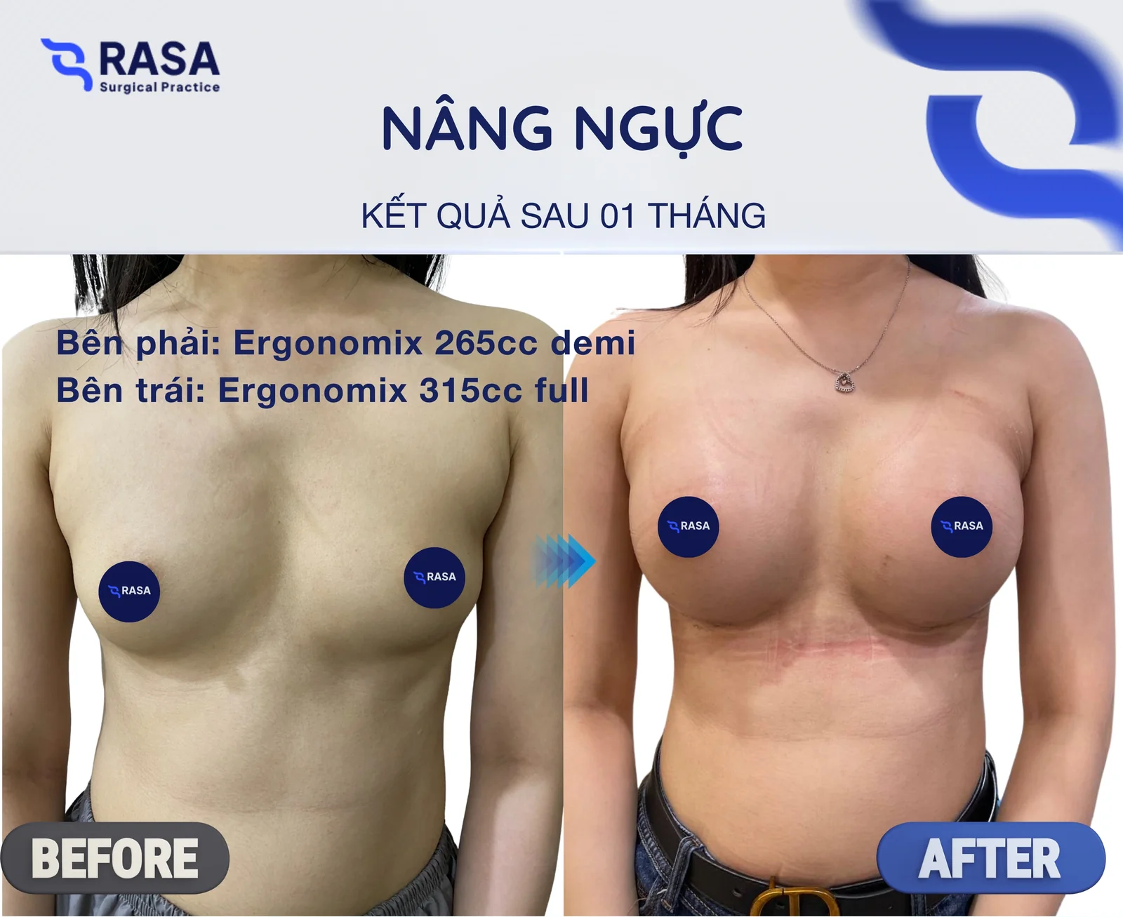 Nâng ngực · Ergonomix 265/315cc - Sau 1 tháng