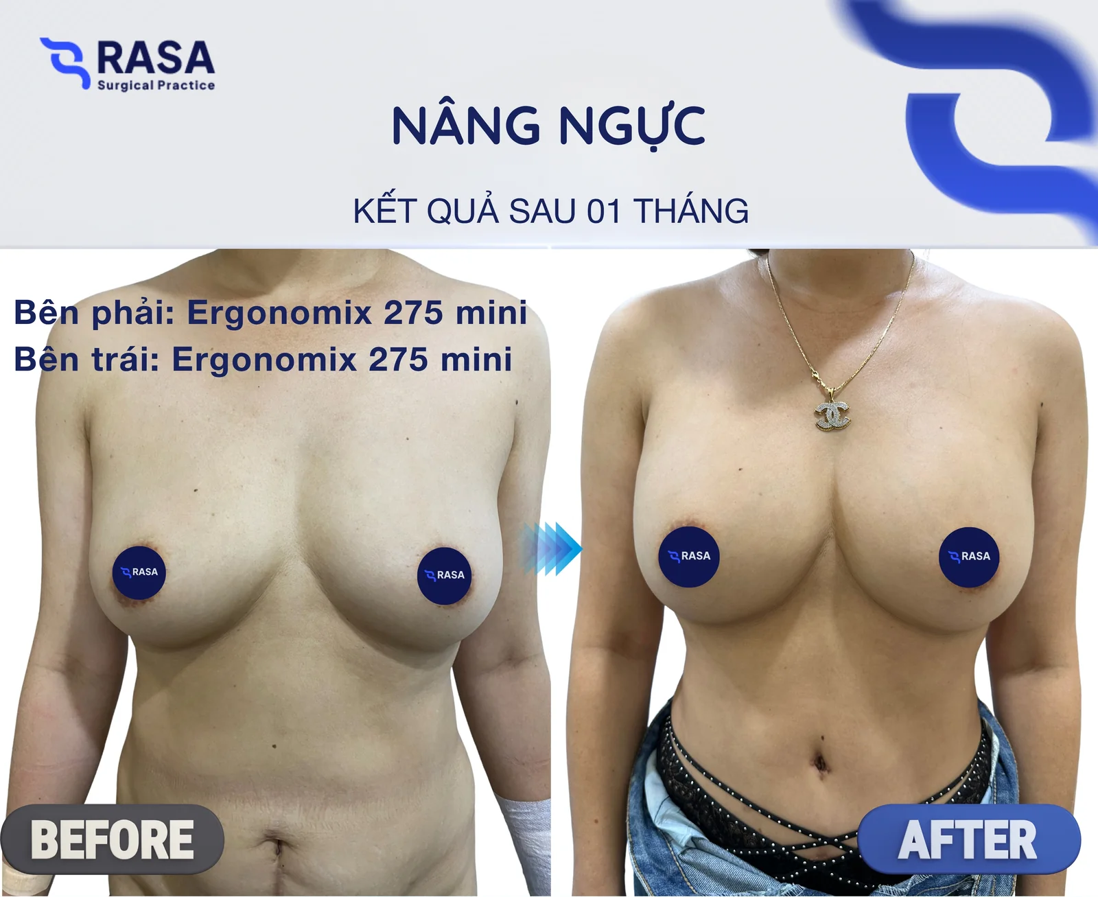 Nâng ngực · Ergonomix 275cc (Mini) - Sau 1 tháng