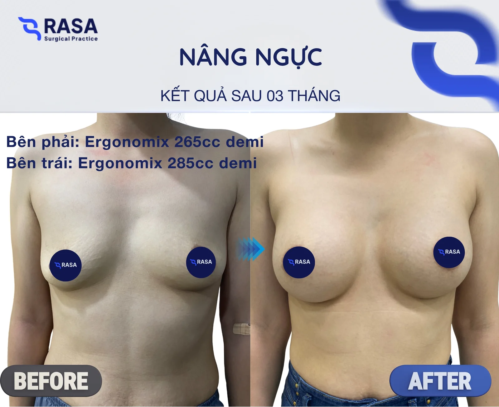 Nâng ngực · Ergonomix 265/285cc - Sau 3 tháng