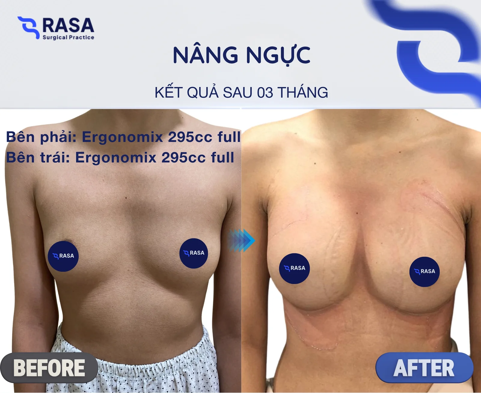 Nâng ngực · Ergonomix 295cc - Sau 3 tháng
