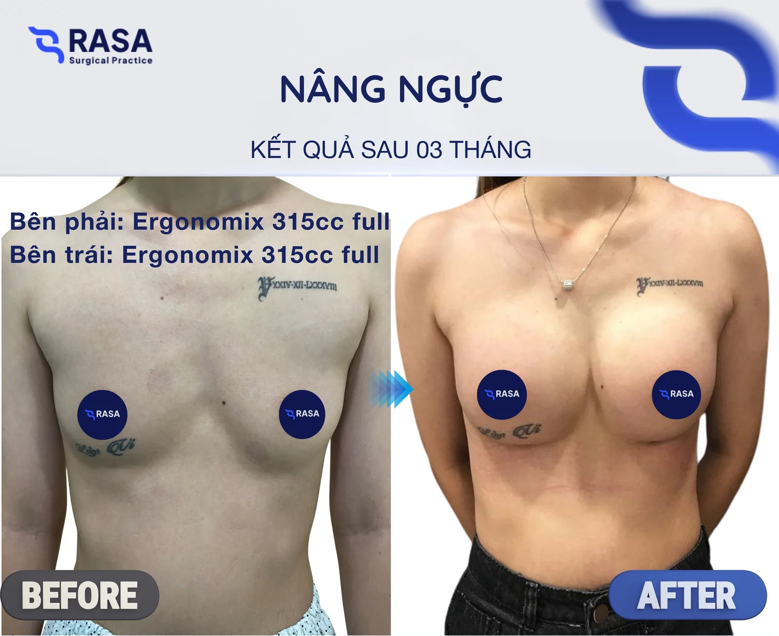 Nâng ngực · Ergonomix 315cc - Sau 3 tháng