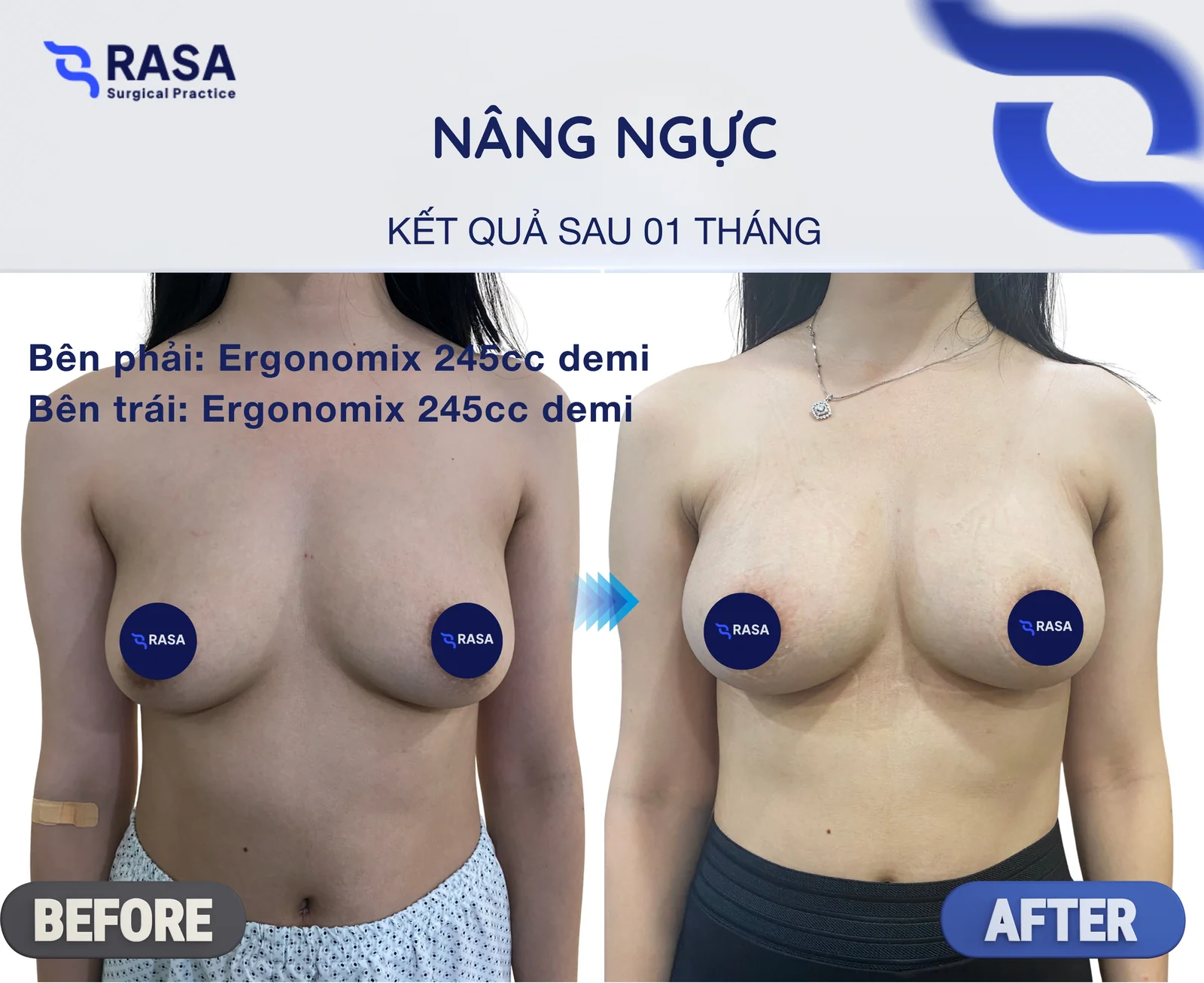 Nâng ngực · Ergonomix 245cc - Sau 1 tháng
