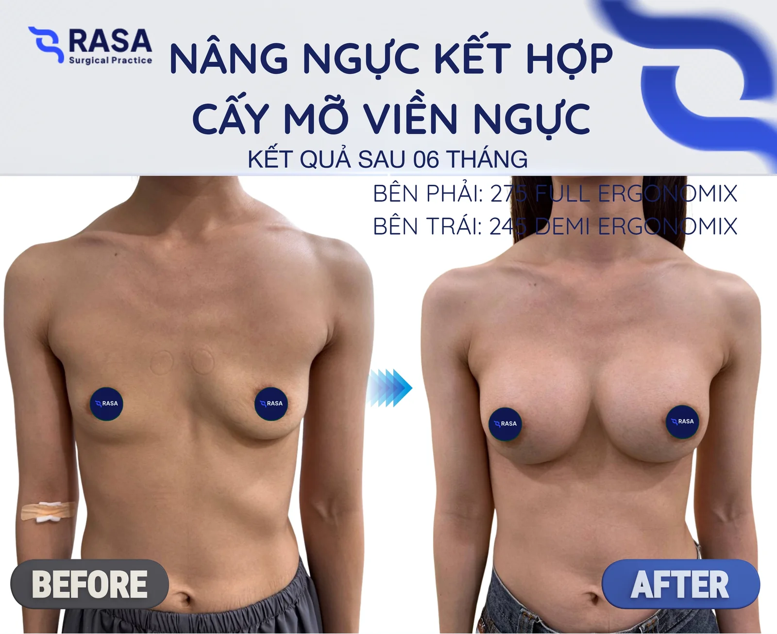 Nâng ngực kết hợp cấy mỡ viền - Sau 6 tháng