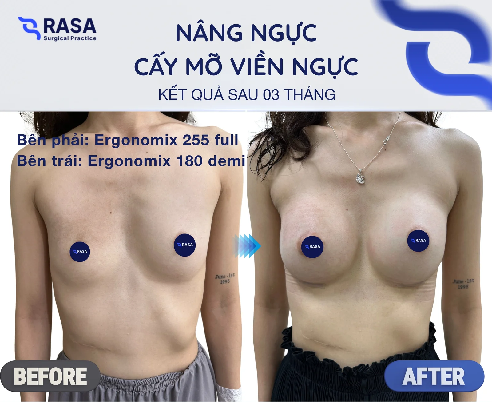 Nâng ngực + cấy mỡ viền · Ergonomix 255/180cc - Sau 3 tháng