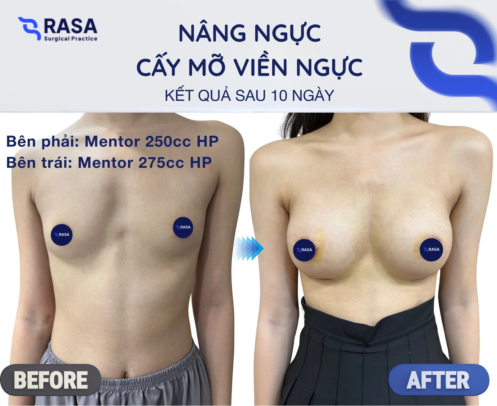 Nâng ngực + cấy mỡ viền · Mentor 250/275cc - Sau 10 ngày