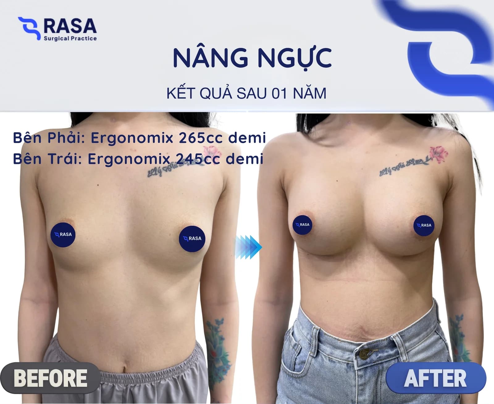 Nâng ngực · Ergonomix 265/245cc - Sau 1 năm