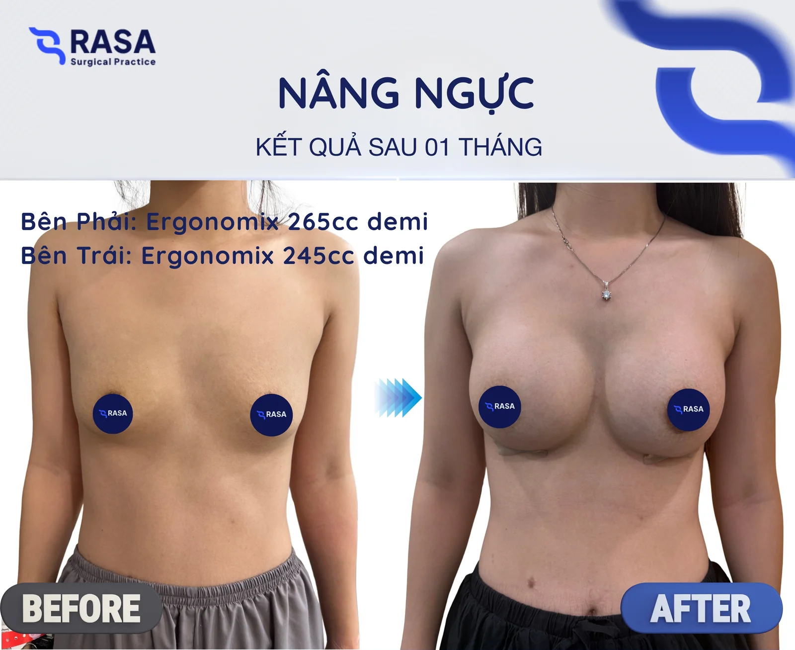 Nâng ngực · Ergonomix 265/245cc - Sau 1 tháng