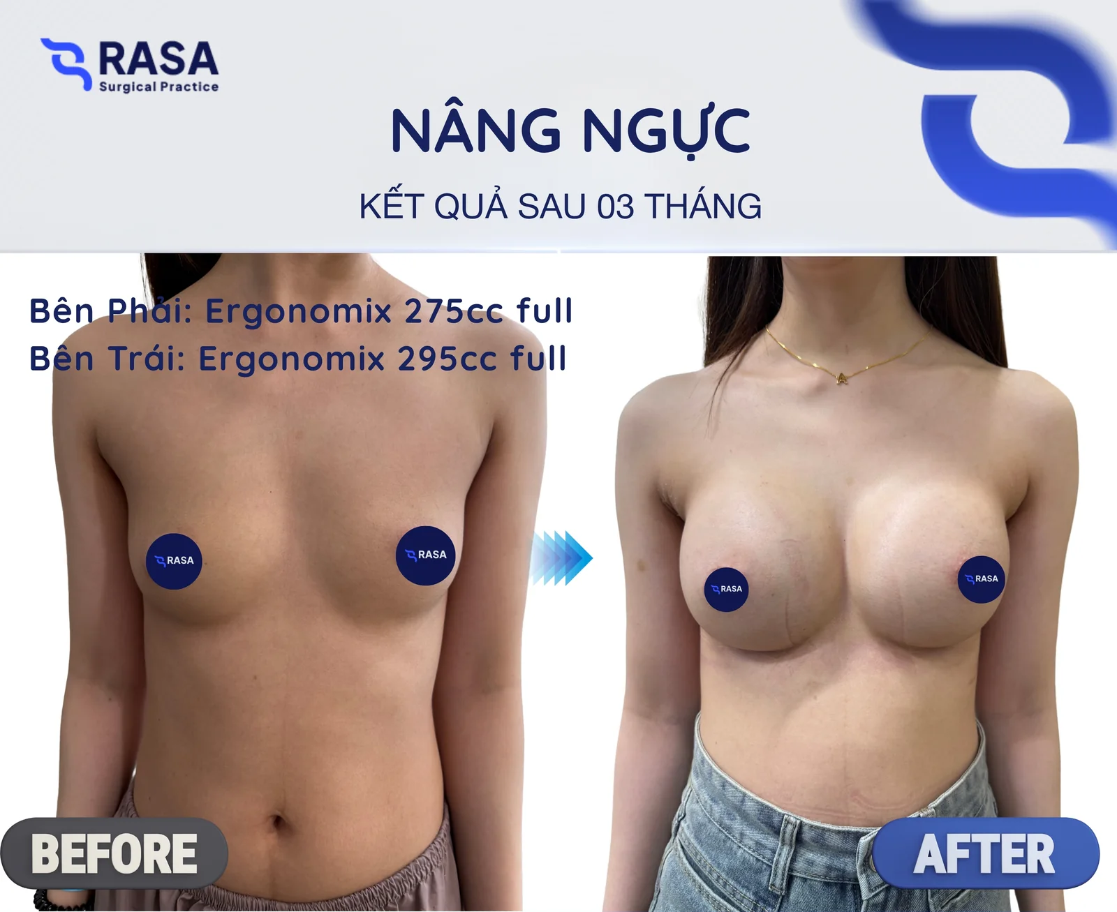 Nâng ngực · Ergonomix 275/295cc - Sau 3 tháng