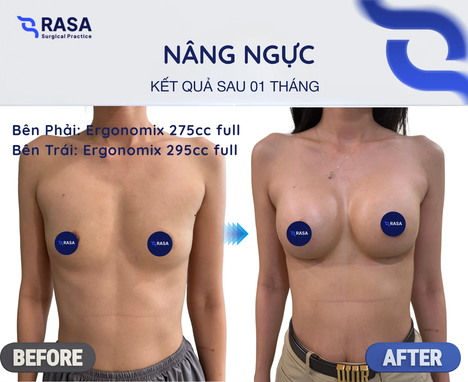 Nâng ngực · Ergonomix 275/295cc - Sau 1 tháng