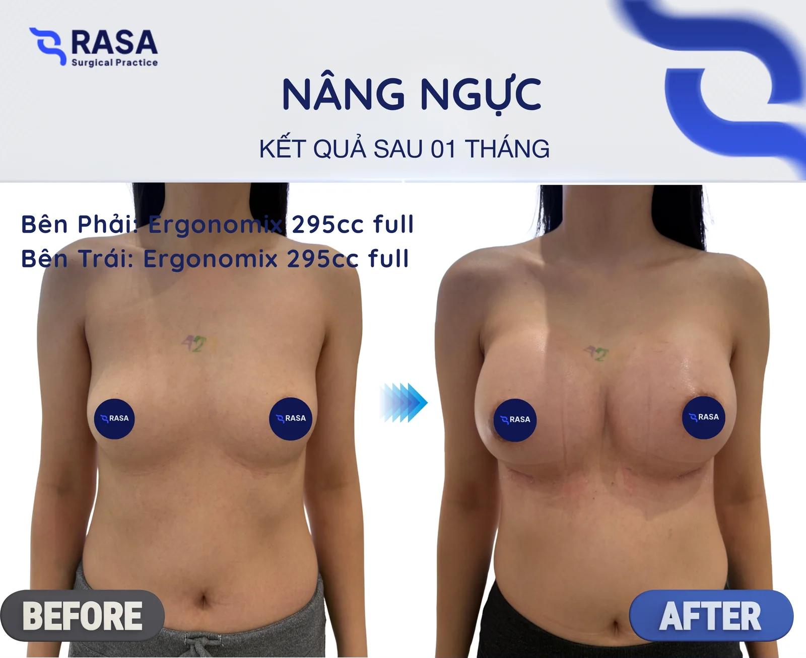 Nâng ngực · Ergonomix 295cc - Sau 1 tháng