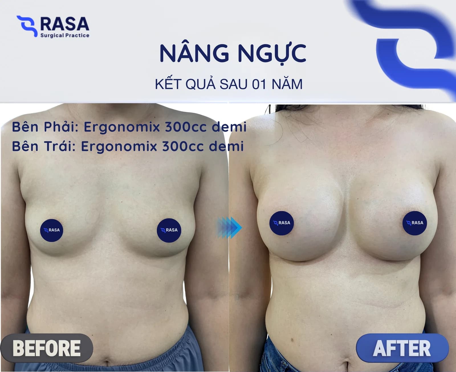 Nâng ngực · Ergonomix 300cc - Sau 1 năm