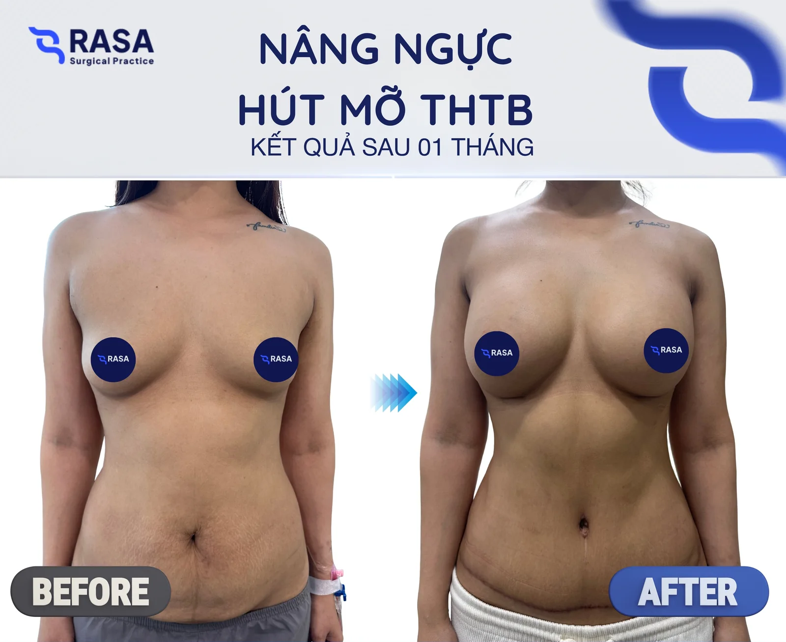 Nâng ngực kết hợp hút mỡ tạo hình thành bụng - Sau 1 tháng