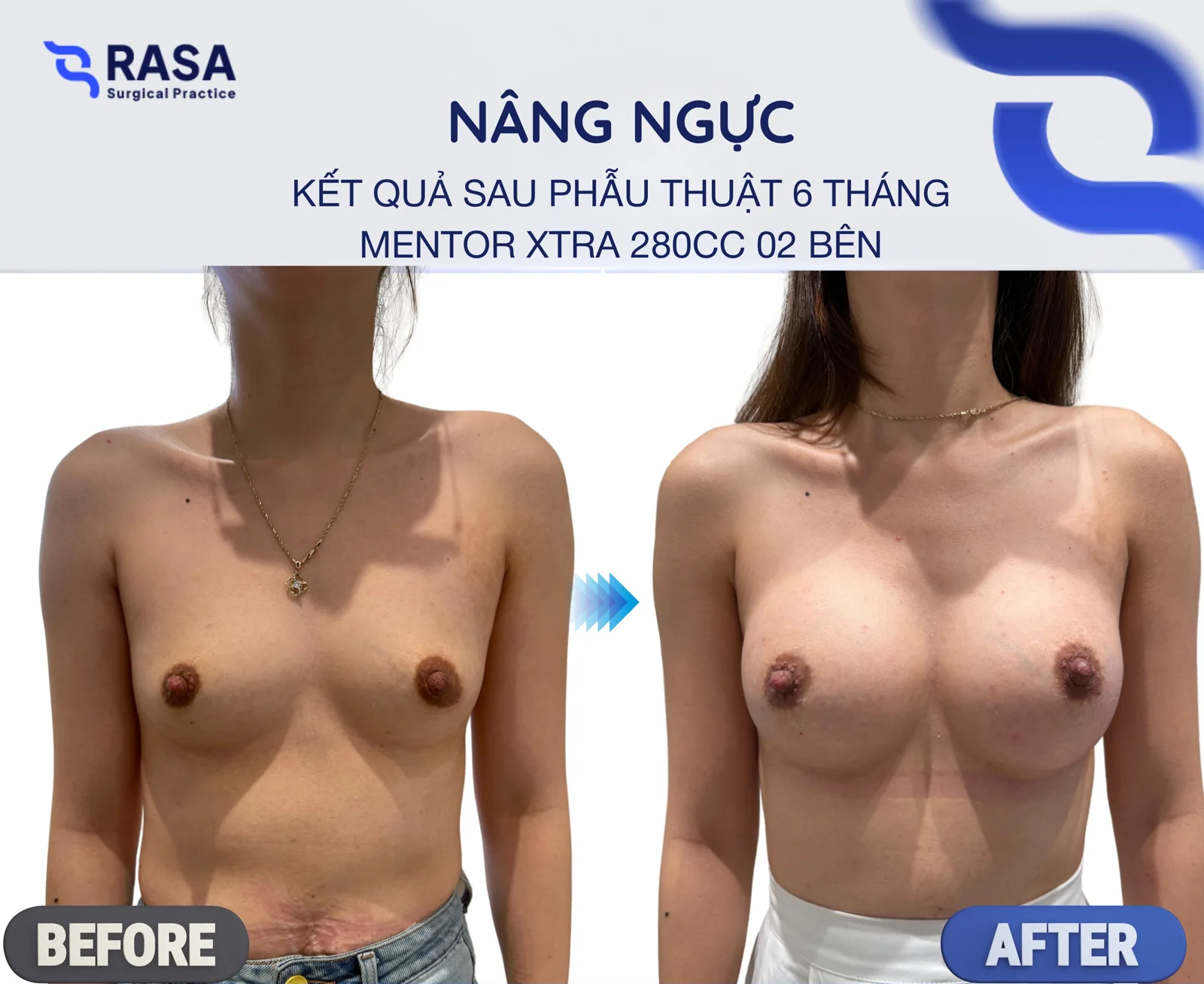 Nâng ngực · Mentor Xtra 280cc - Sau 6 tháng
