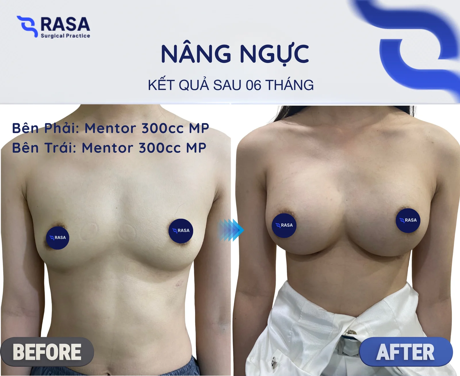 Nâng ngực · Mentor 300cc - Sau 6 tháng